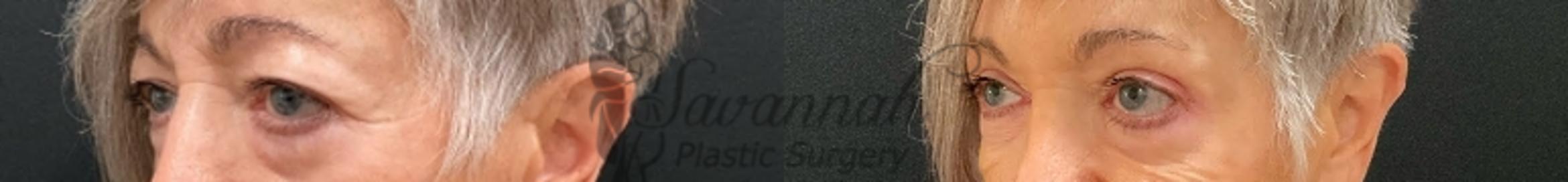 Before & After Eyelid Surgery Case 90 Left Oblique View in Savannah, Georgia