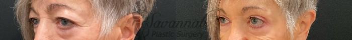Before & After Eyelid Surgery Case 90 Left Oblique View in Savannah, Georgia