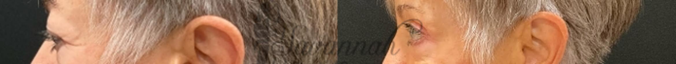 Before & After Eyelid Surgery Case 90 Left Side View in Savannah, Georgia