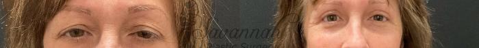 Before & After Eyelid Surgery Case 95 Front View in Savannah, Georgia