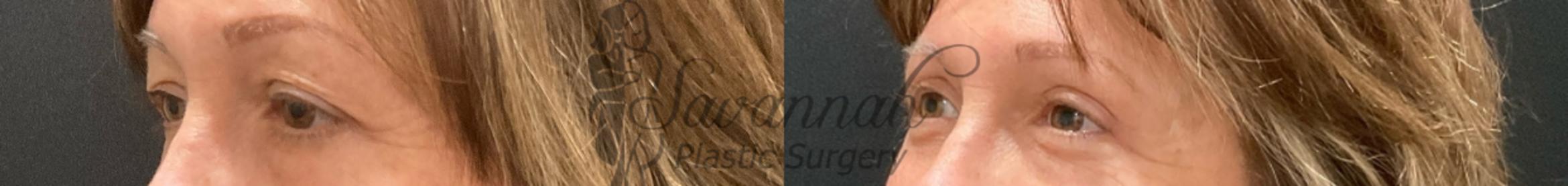 Before & After Eyelid Surgery Case 95 Left Oblique View in Savannah, Georgia