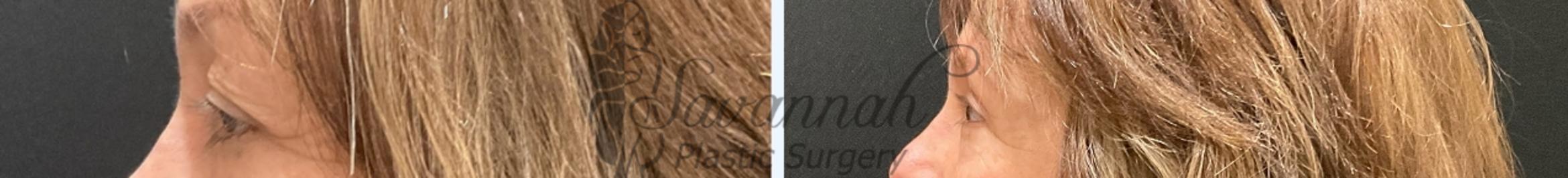 Before & After Eyelid Surgery Case 95 Left Side View in Savannah, Georgia
