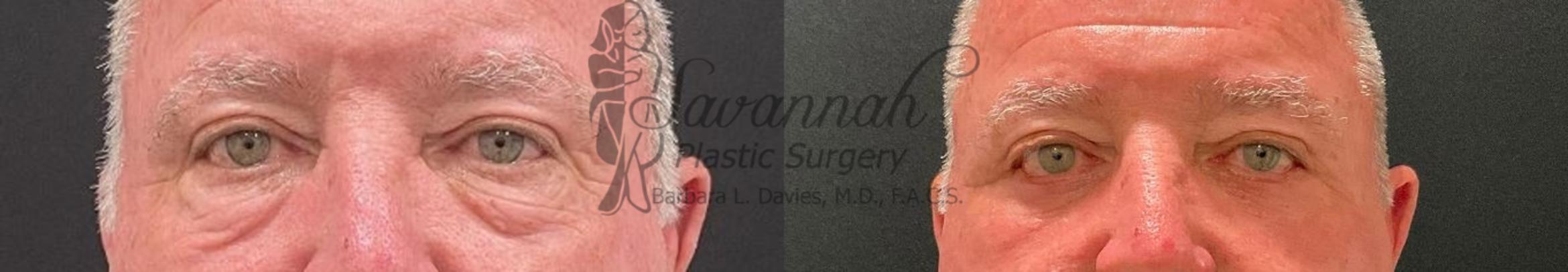 Before & After Eyelid Surgery Case 96 Front View in Savannah, Georgia
