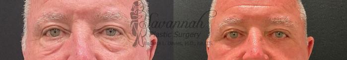 Before & After Eyelid Surgery Case 96 Front View in Savannah, Georgia