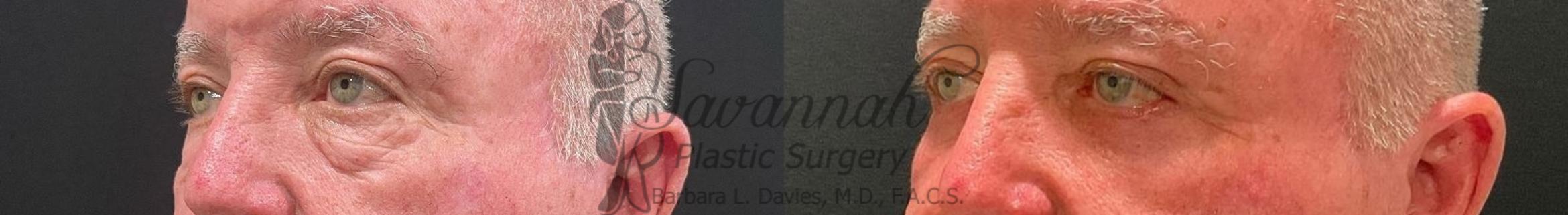 Before & After Eyelid Surgery Case 96 Left Oblique View in Savannah, Georgia