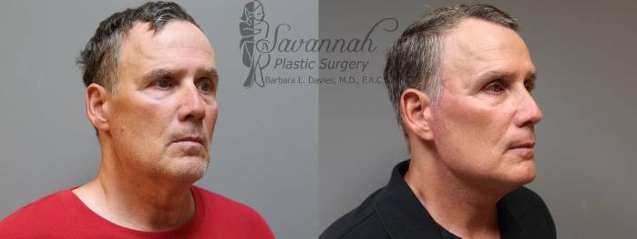 Before & After Facelift Case 69 View 2 View in Savannah, Georgia