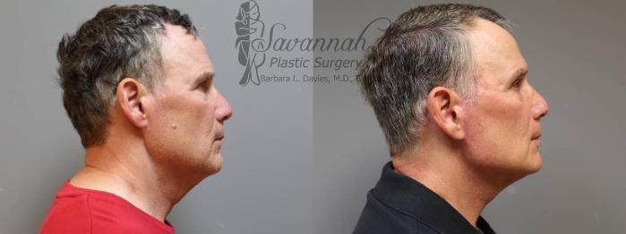 Before & After Facelift Case 69 View 3 View in Savannah, Georgia