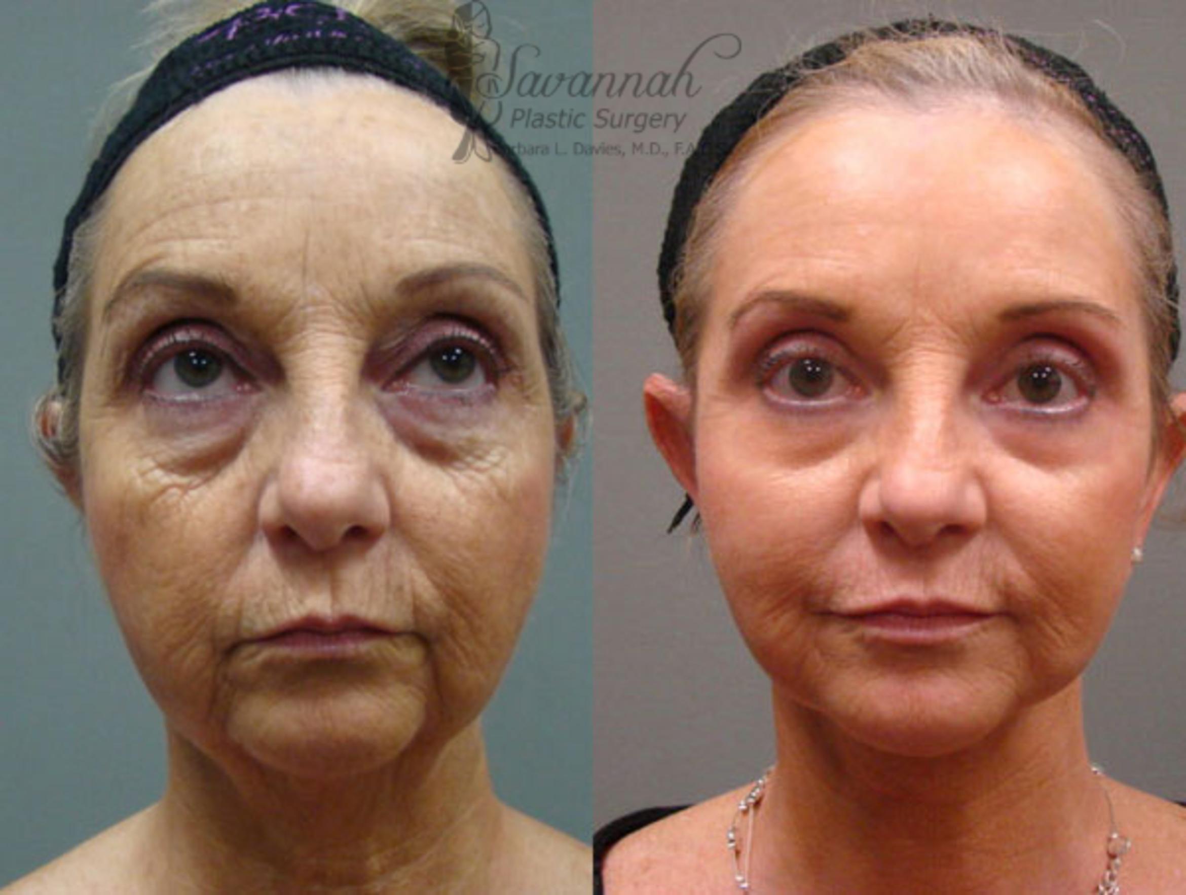 Before & After Facelift Case 70 View 1 View in Savannah, Georgia