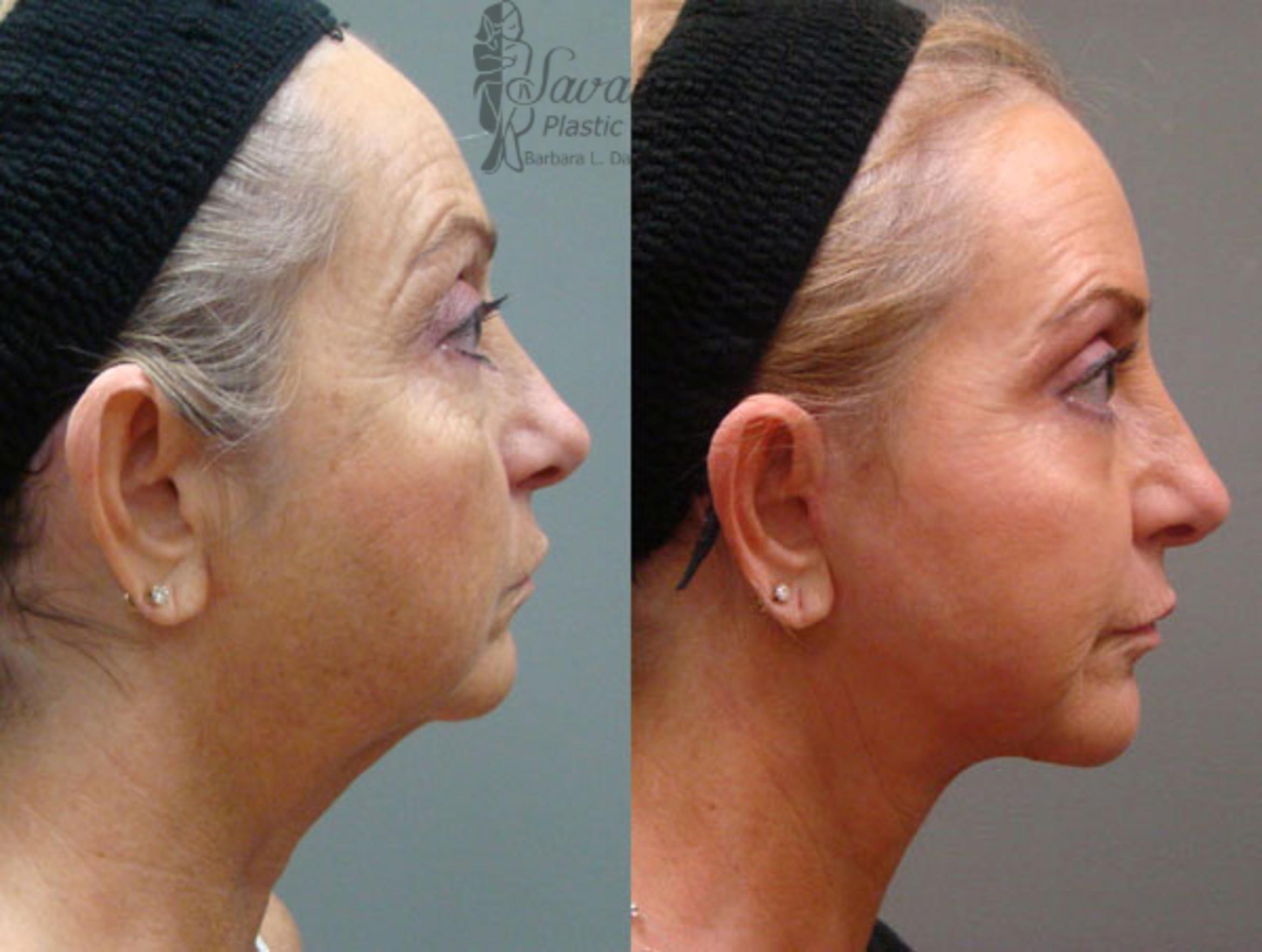 Before & After Facelift Case 70 View 2 View in Savannah, Georgia