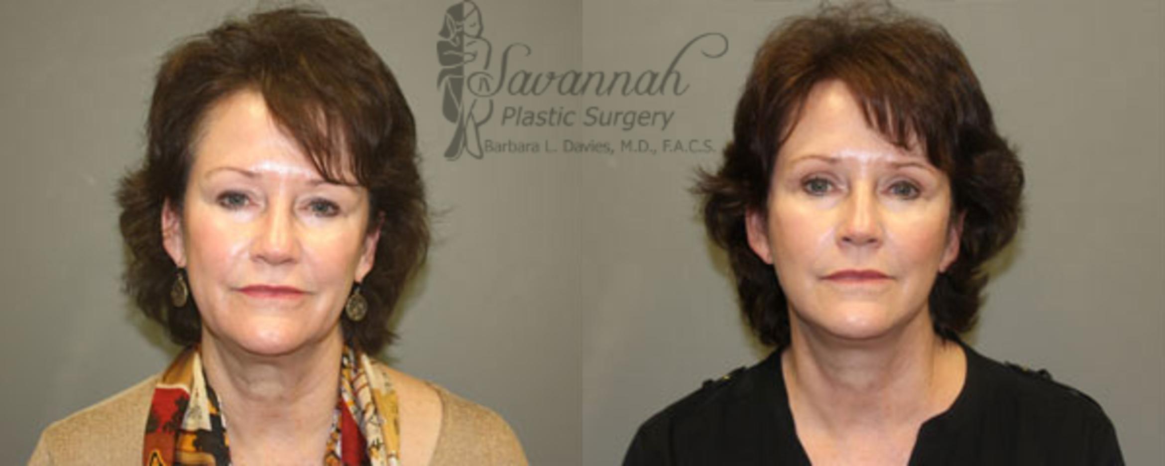 Before & After Facelift Case 71 View 1 View in Savannah, Georgia