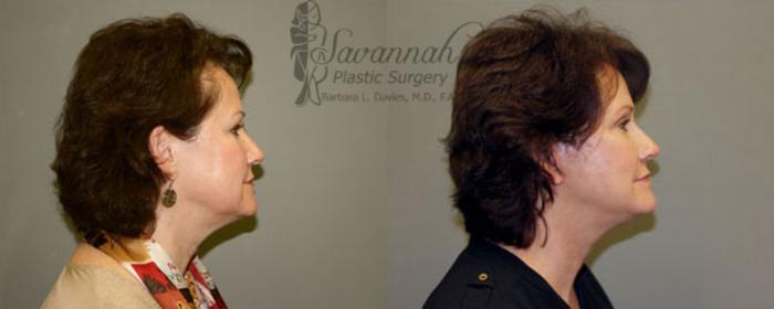 Before & After Facelift Case 71 View 2 View in Savannah, Georgia