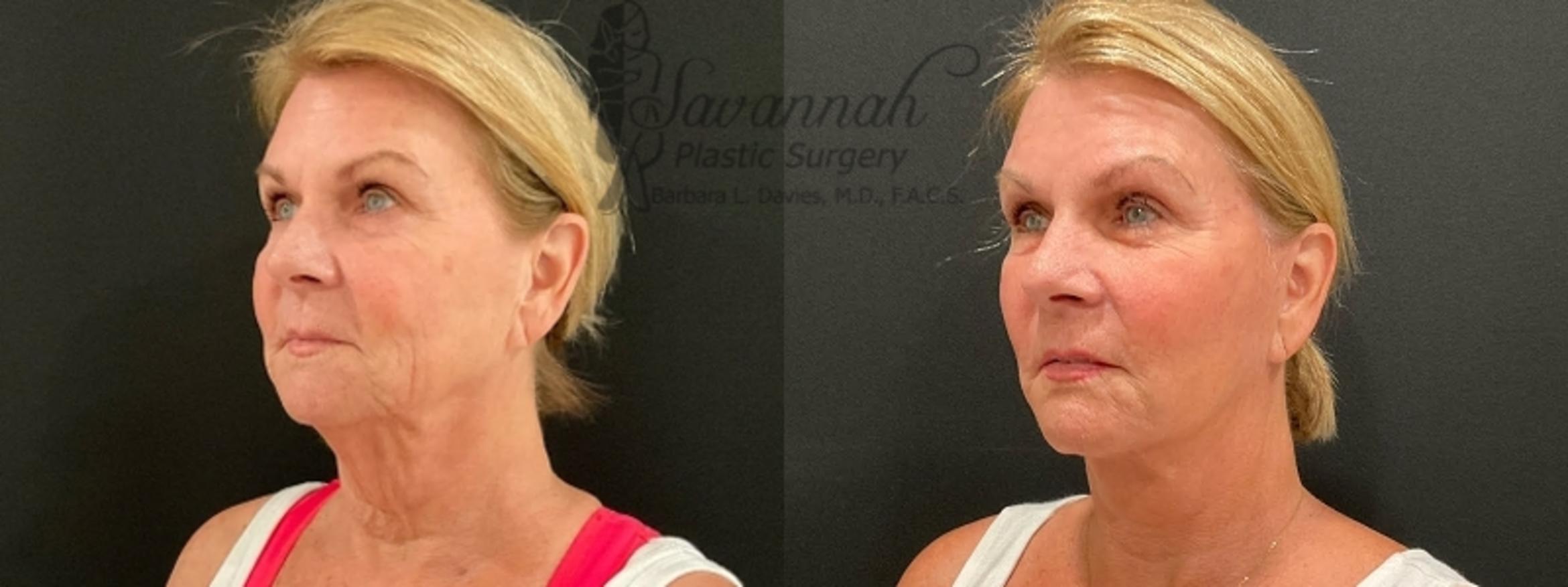 Before & After Facelift Case 87 Left Oblique View in Savannah, Georgia