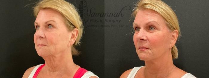 Before & After Facelift Case 87 Left Oblique View in Savannah, Georgia