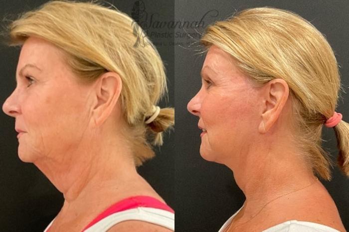 Before & After Facelift Case 87 Left Side View in Savannah, Georgia