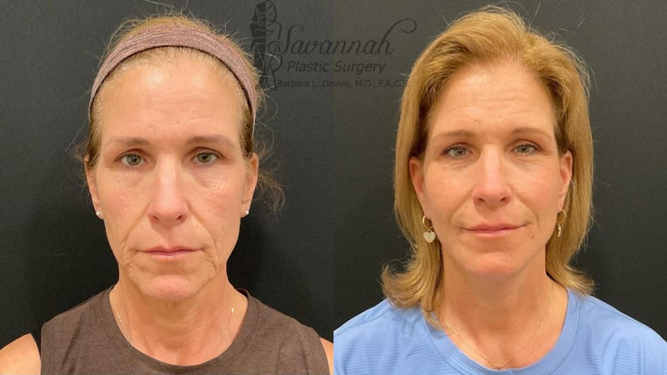 Before & After Facelift Case 99 Front View in Savannah, Georgia