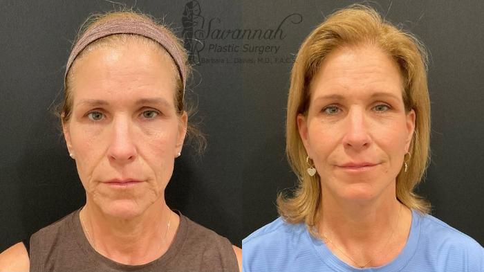 Before & After Facelift Case 99 Front View in Savannah, Georgia