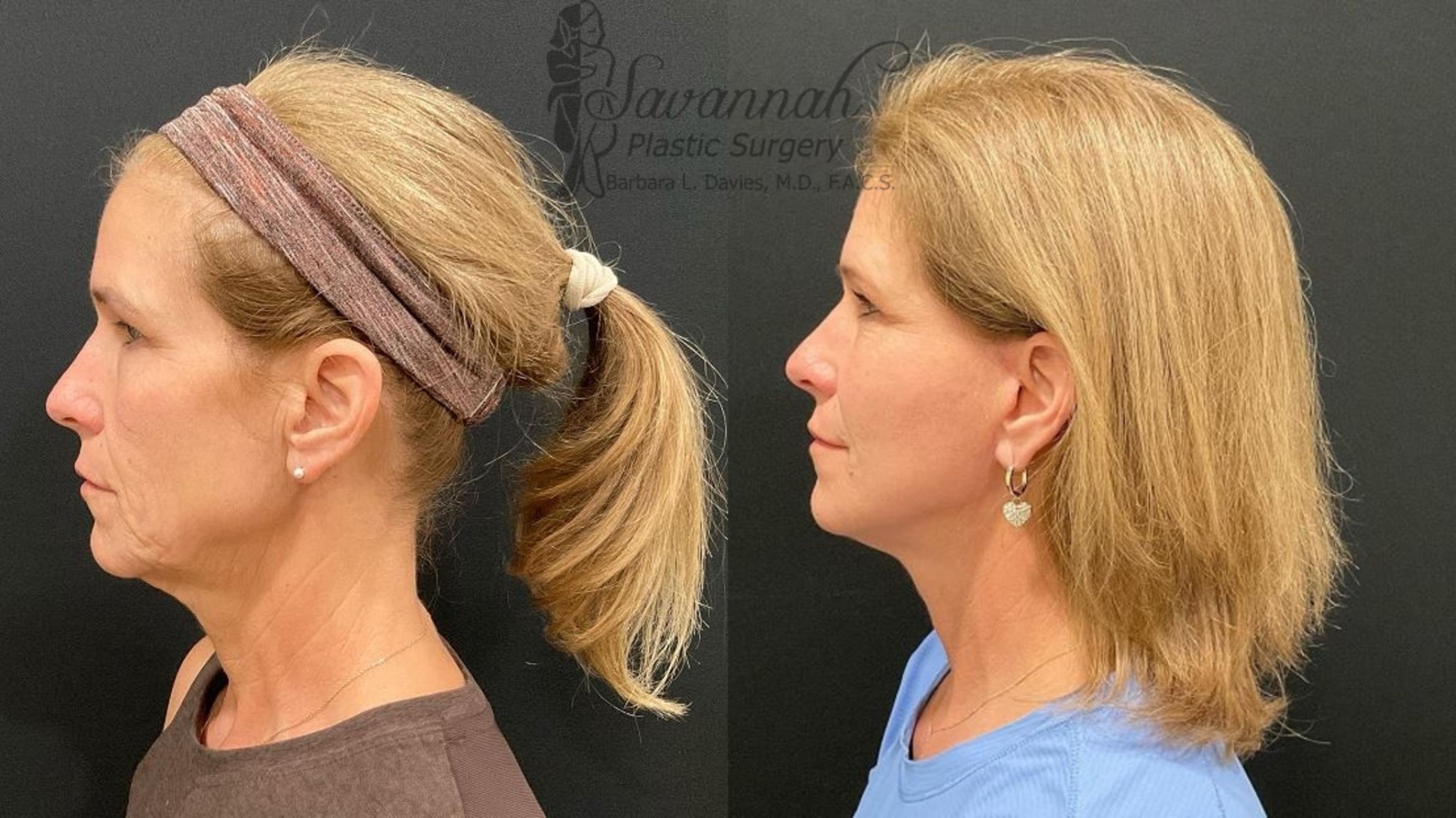 Before & After Facelift Case 99 Left Side View in Savannah, Georgia