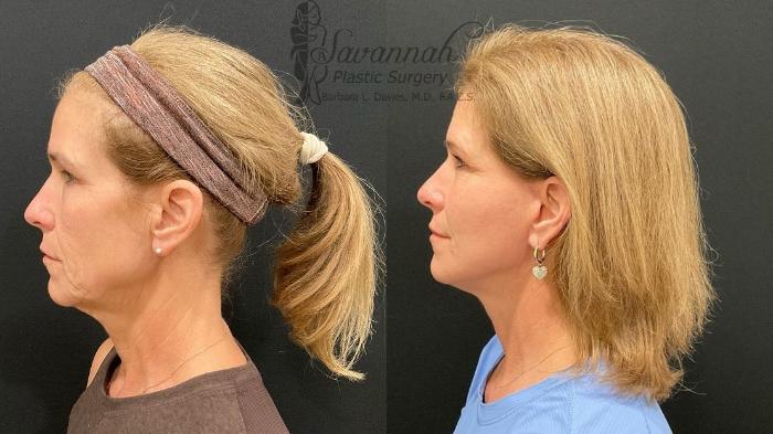 Before & After Facelift Case 99 Left Side View in Savannah, Georgia