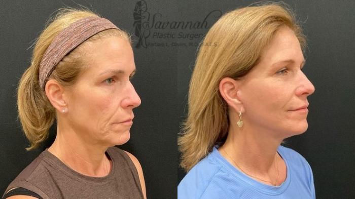Before & After Facelift Case 99 Right Oblique View in Savannah, Georgia
