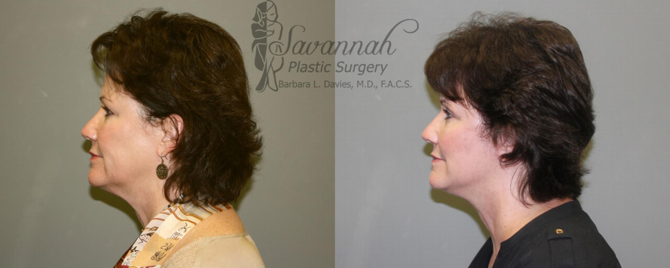 Before & After Facelift Case 72 View 2 View in Savannah, Georgia