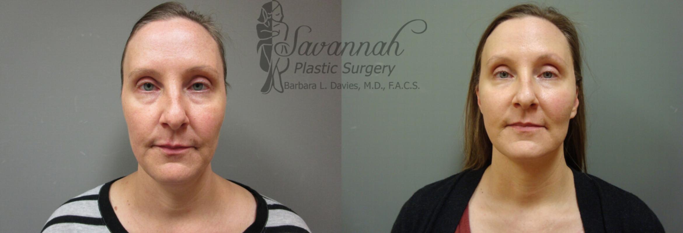 Before & After FreshLook Lift® Case 73 View 1 View in Savannah, Georgia