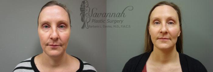 Before & After FreshLook Lift® Case 73 View 1 View in Savannah, Georgia