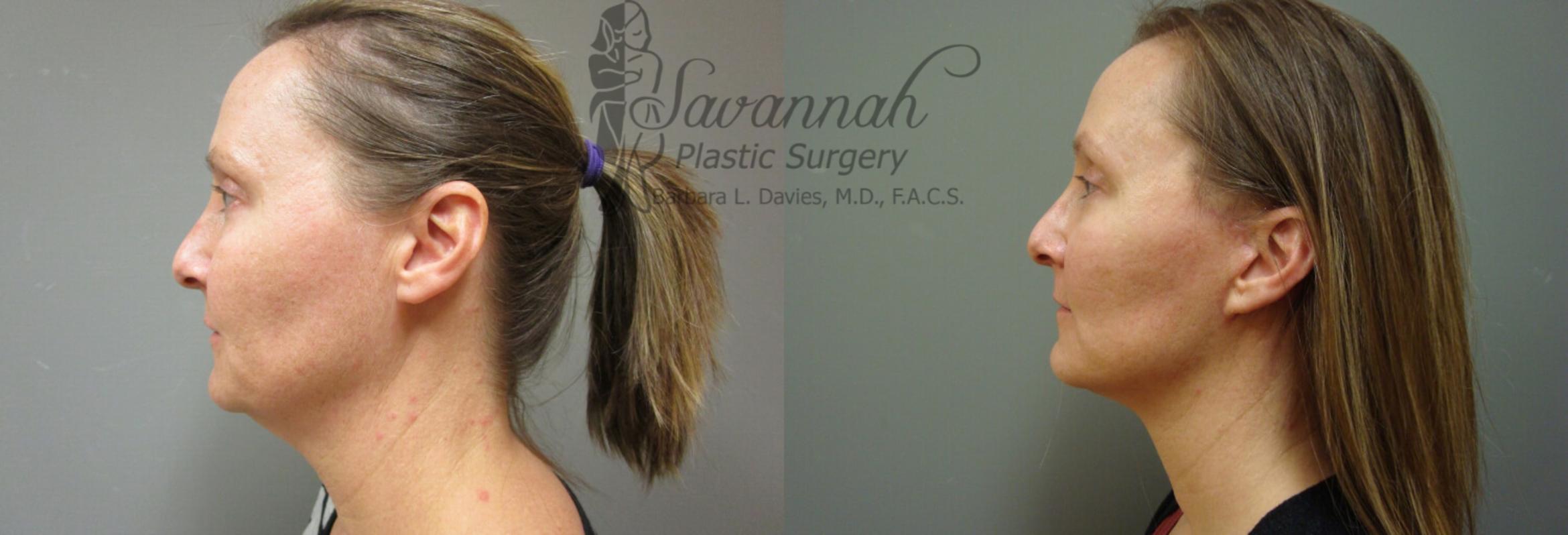 Before & After FreshLook Lift® Case 73 View 2 View in Savannah, Georgia