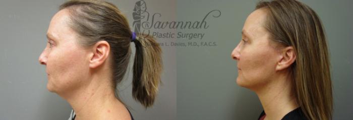 Before & After FreshLook Lift® Case 73 View 2 View in Savannah, Georgia