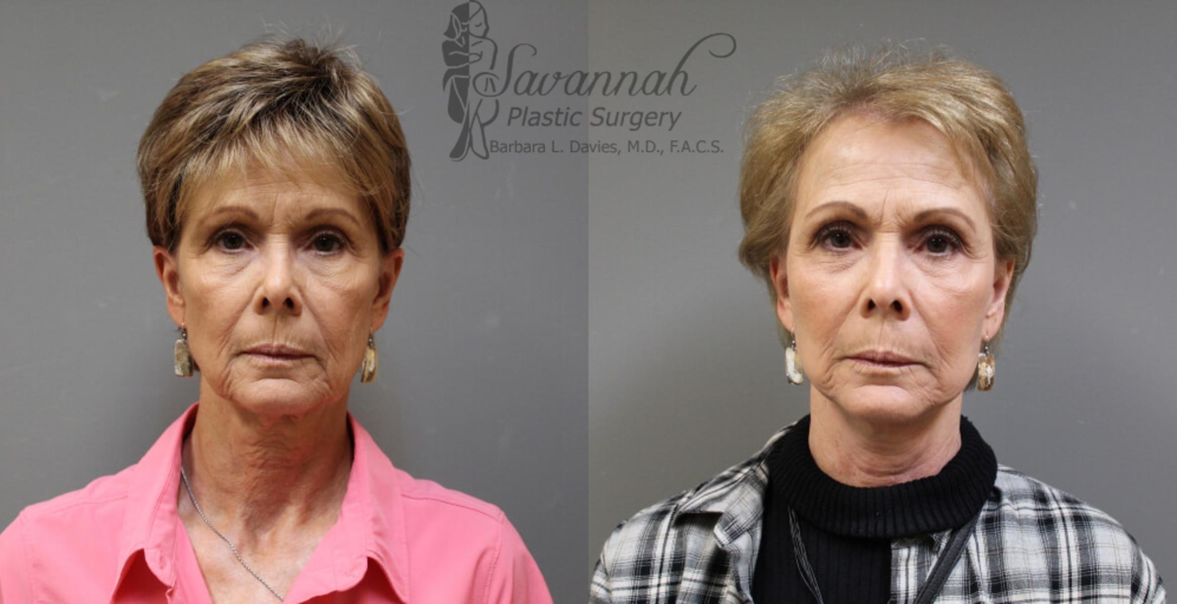 Before & After FreshLook Lift® Case 74 View 1 View in Savannah, Georgia