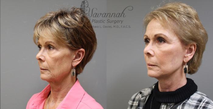 Before & After FreshLook Lift® Case 74 View 2 View in Savannah, Georgia