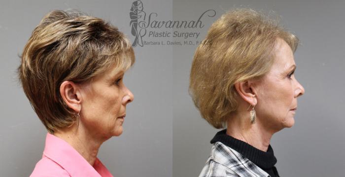 Before & After FreshLook Lift® Case 74 View 3 View in Savannah, Georgia