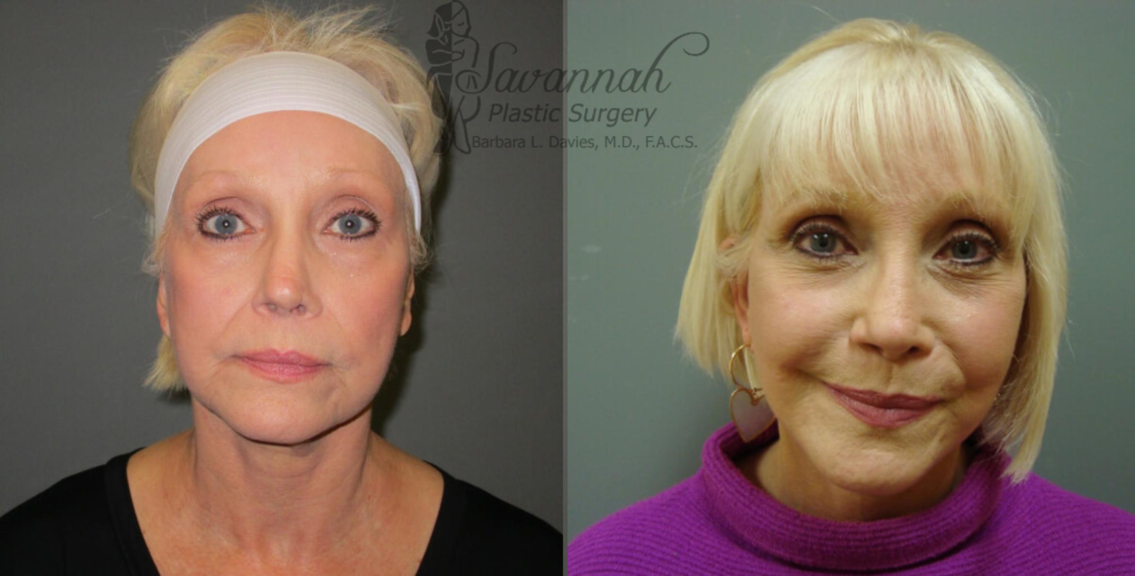 Before & After FreshLook Lift® Case 75 View 1 View in Savannah, Georgia