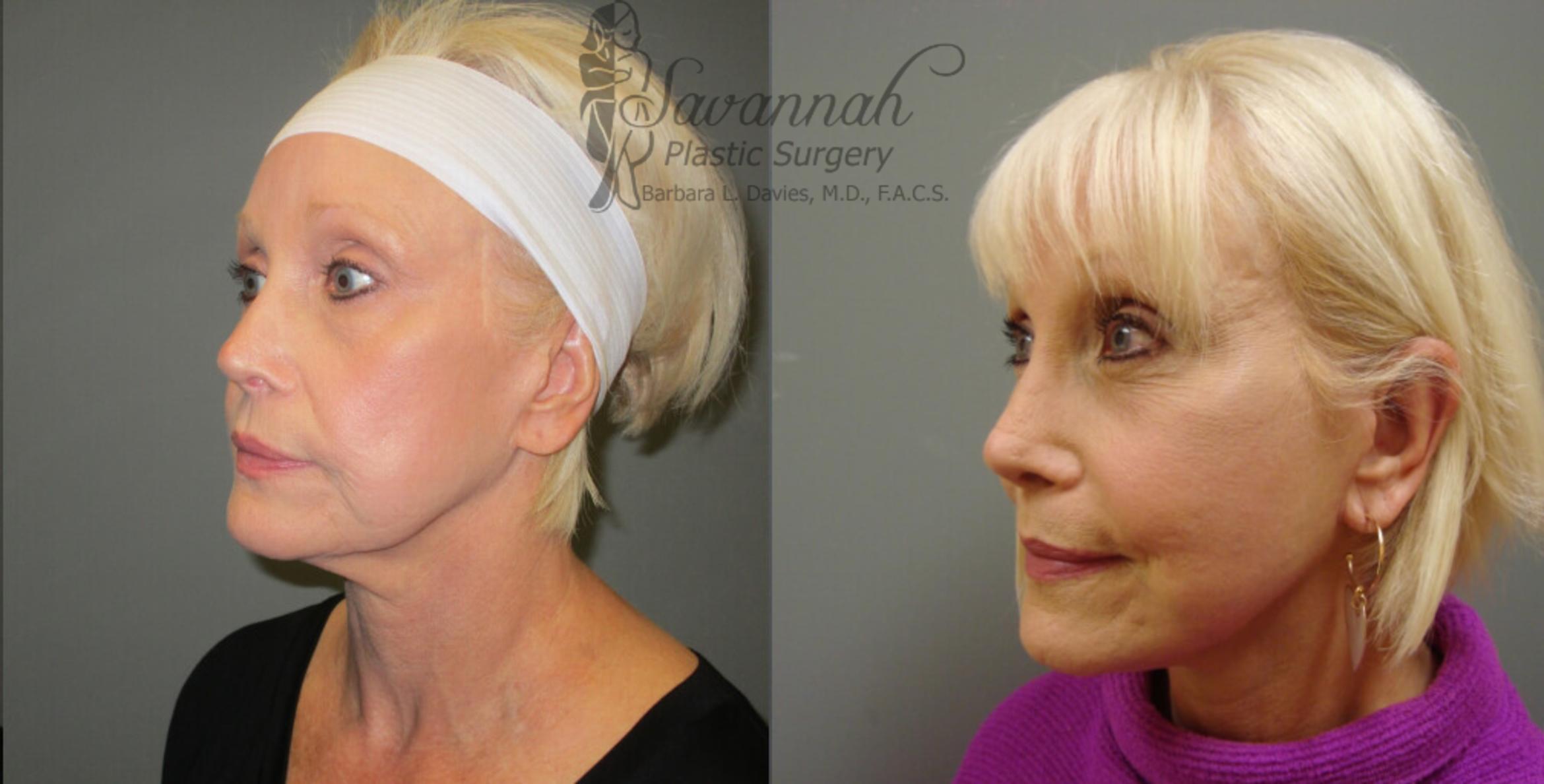 Before & After FreshLook Lift® Case 75 View 2 View in Savannah, Georgia