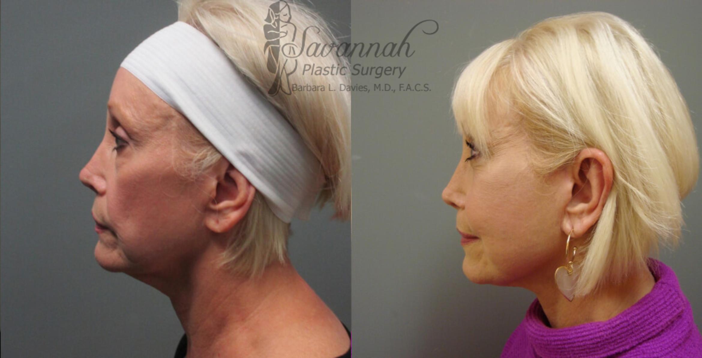 Before & After FreshLook Lift® Case 75 View 3 View in Savannah, Georgia