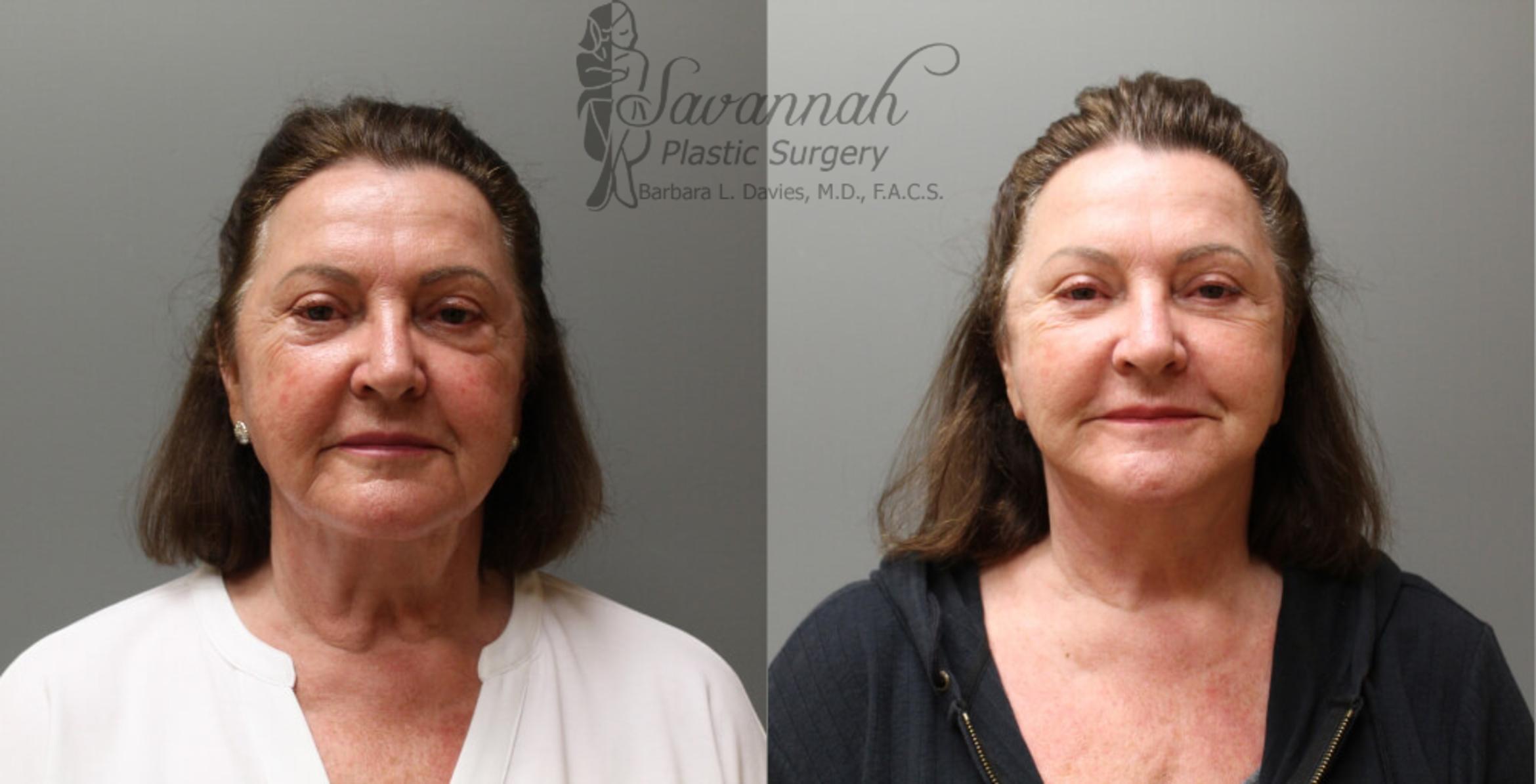 Before & After FreshLook Lift® Case 76 View 1 View in Savannah, Georgia