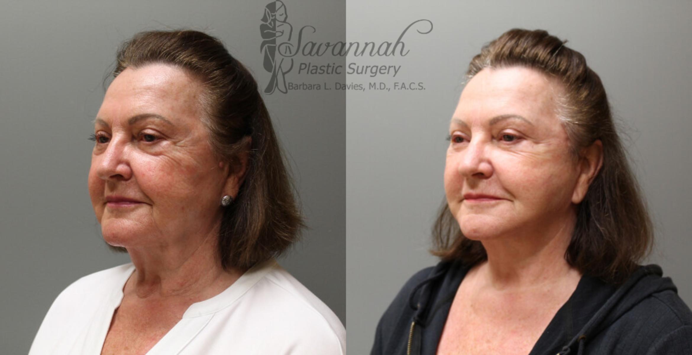 Before & After FreshLook Lift® Case 76 View 2 View in Savannah, Georgia