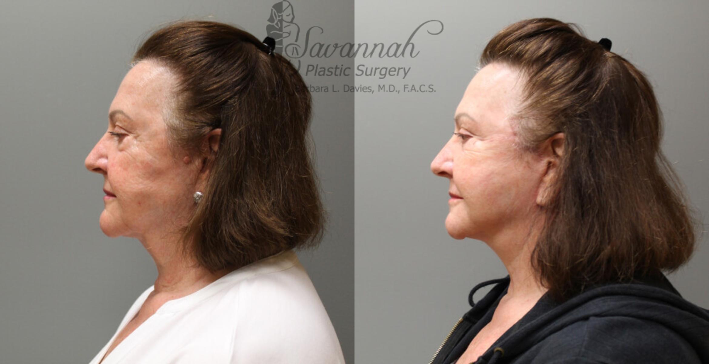 Before & After FreshLook Lift® Case 76 View 3 View in Savannah, Georgia