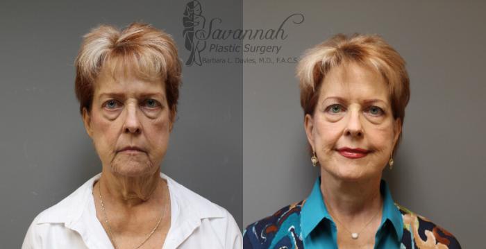 Before & After FreshLook Lift® Case 77 View 1 View in Savannah, Georgia
