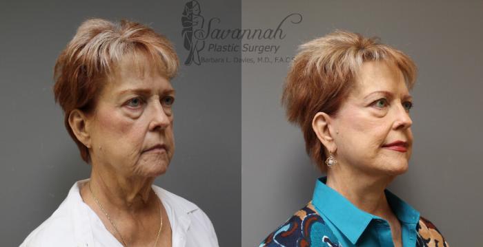 Before & After FreshLook Lift® Case 77 View 2 View in Savannah, Georgia