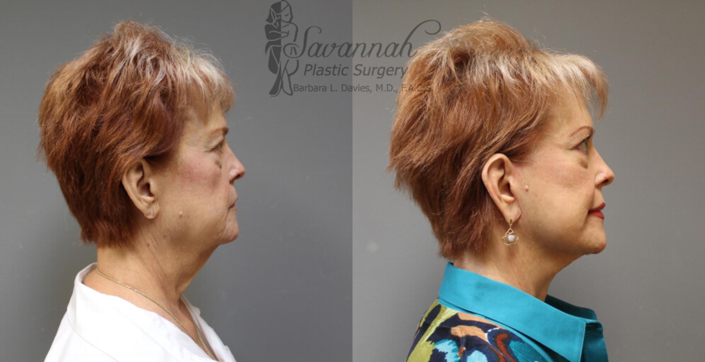 Before & After FreshLook Lift® Case 77 View 3 View in Savannah, Georgia