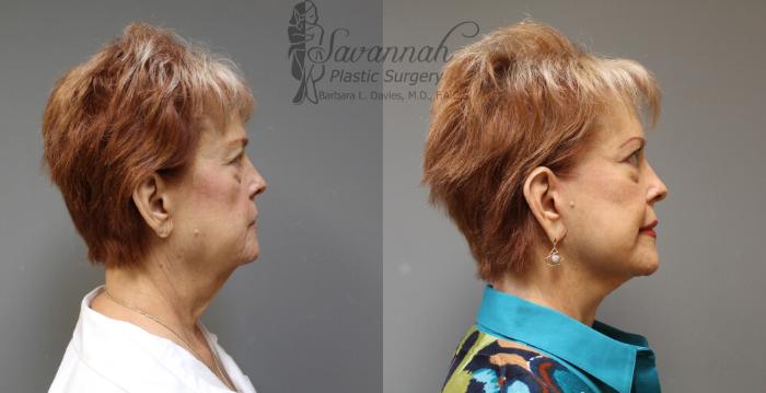 Before & After FreshLook Lift® Case 77 View 3 View in Savannah, Georgia