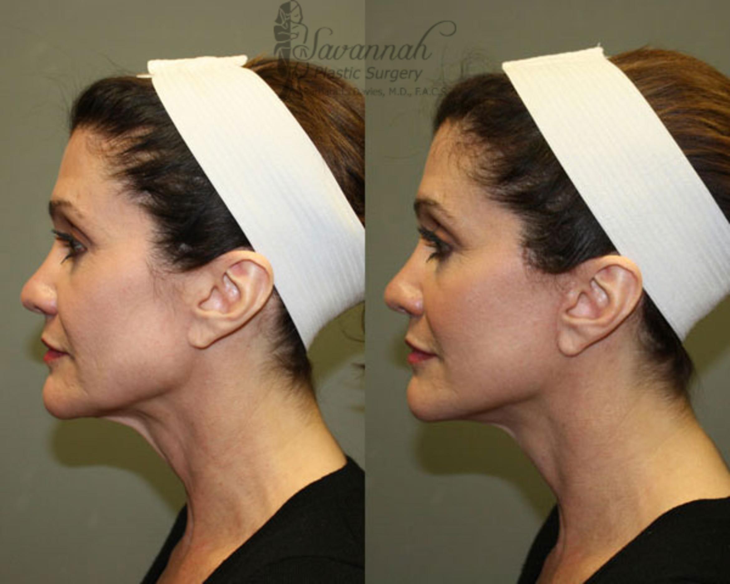 Before & After Facelift Case 78 View 1 View in Savannah, Georgia