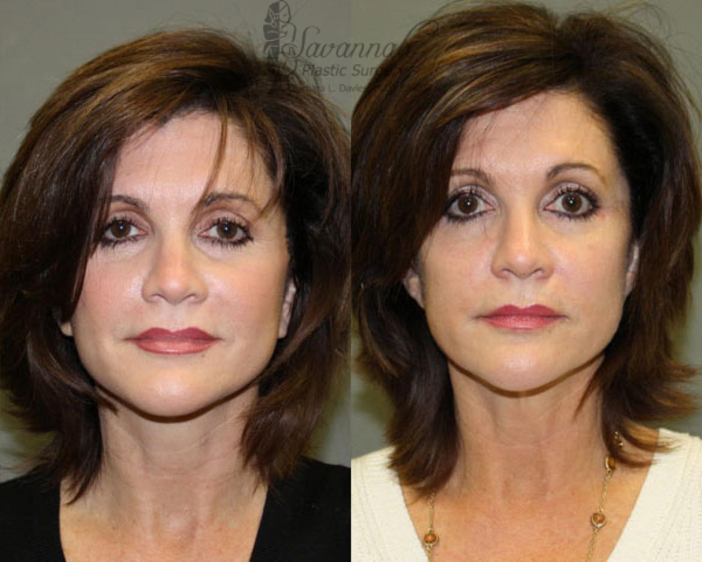 Before & After Facelift Case 78 View 2 View in Savannah, Georgia