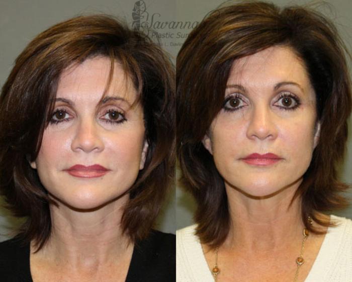 Before & After Facelift Case 78 View 2 View in Savannah, Georgia