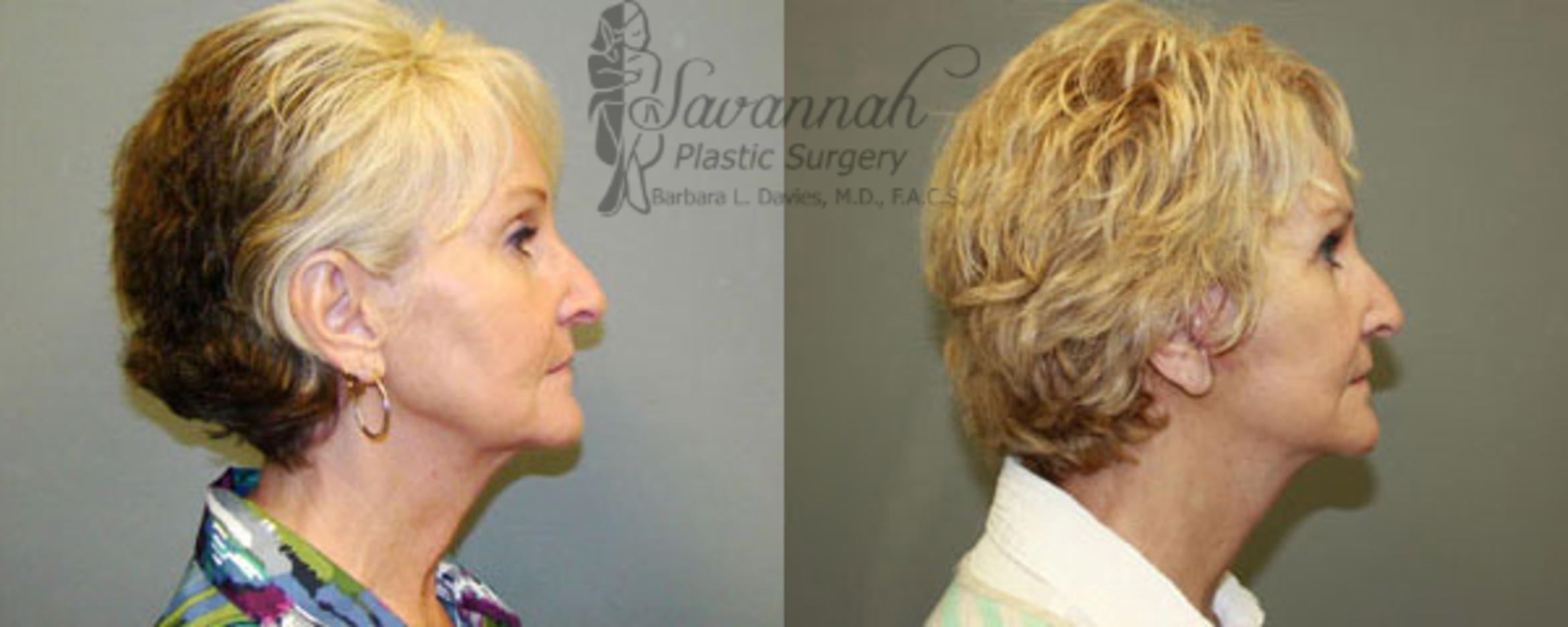 Before & After FreshLook Lift® Case 79 View 2 View in Savannah, Georgia