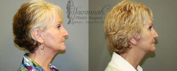 Before & After FreshLook Lift® Case 79 View 2 View in Savannah, Georgia