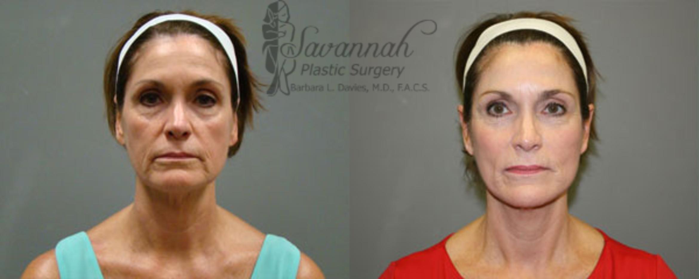Before & After FreshLook Lift® Case 80 View 1 View in Savannah, Georgia