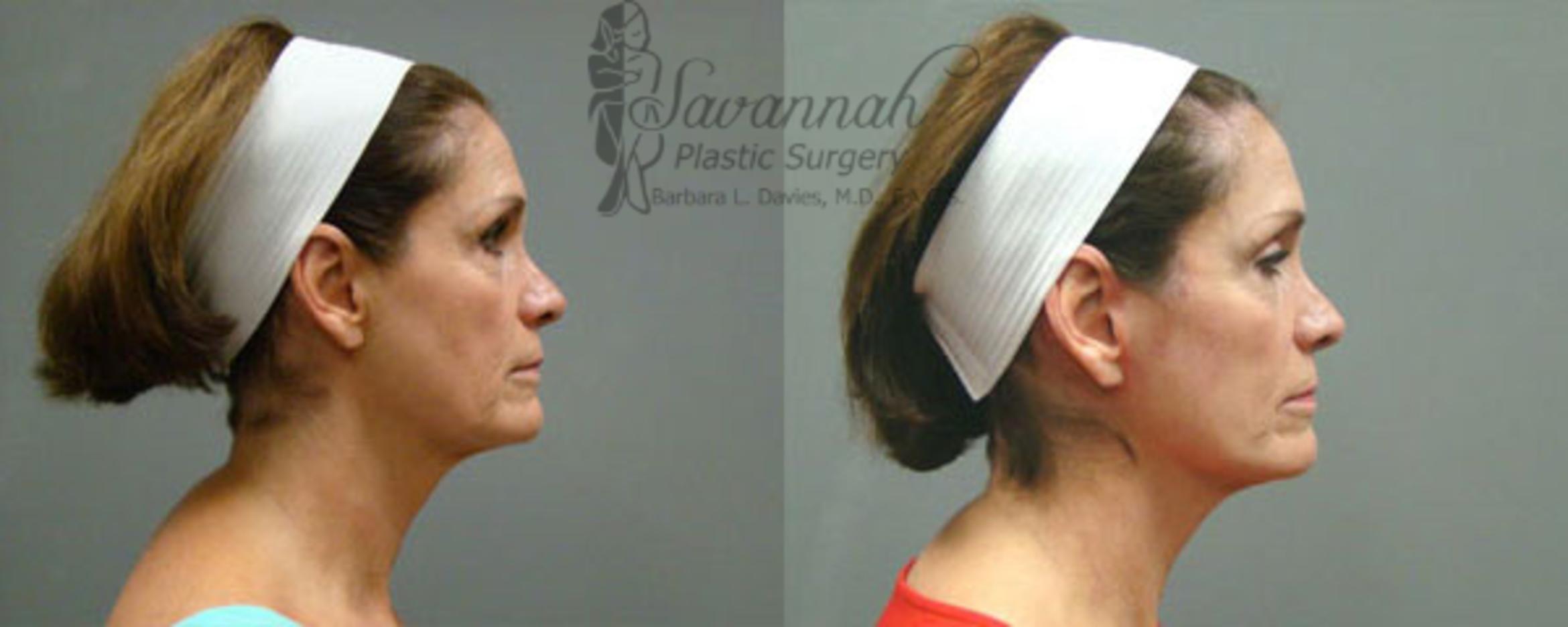 Before & After FreshLook Lift® Case 80 View 2 View in Savannah, Georgia