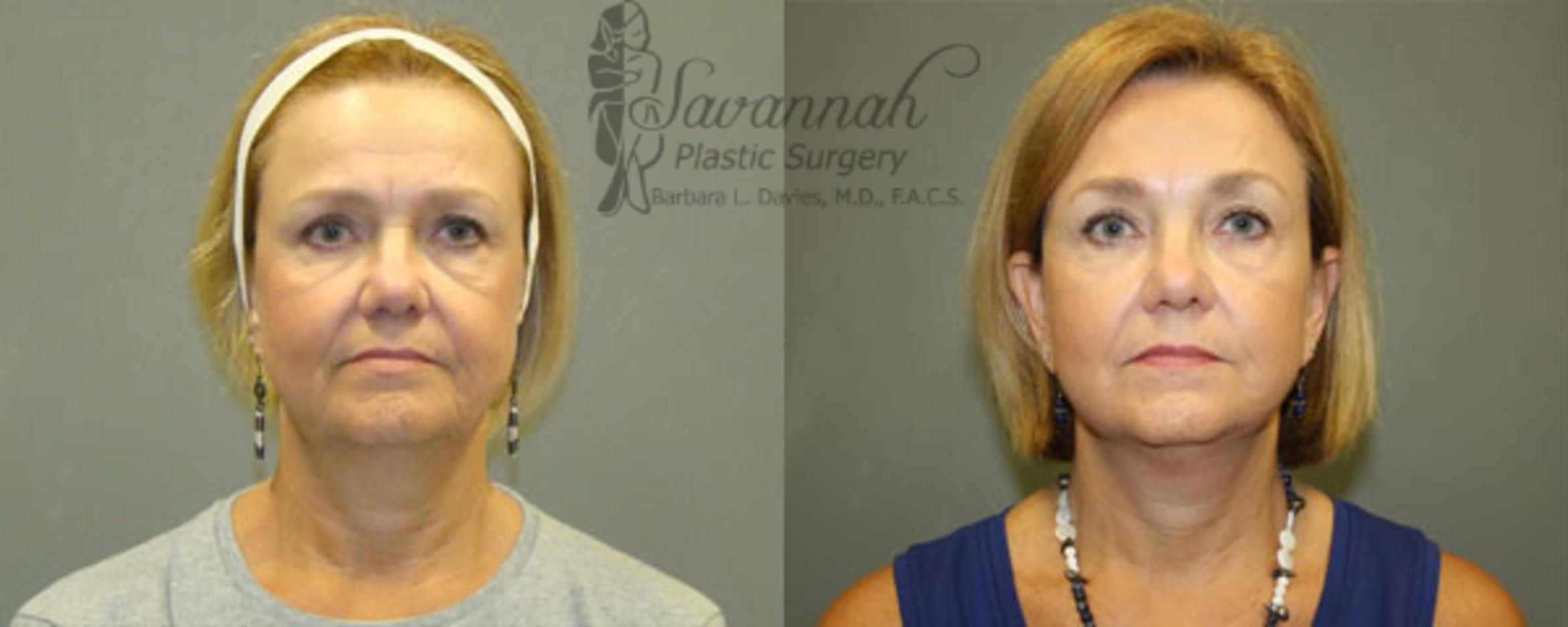Before & After FreshLook Lift® Case 81 View 1 View in Savannah, Georgia