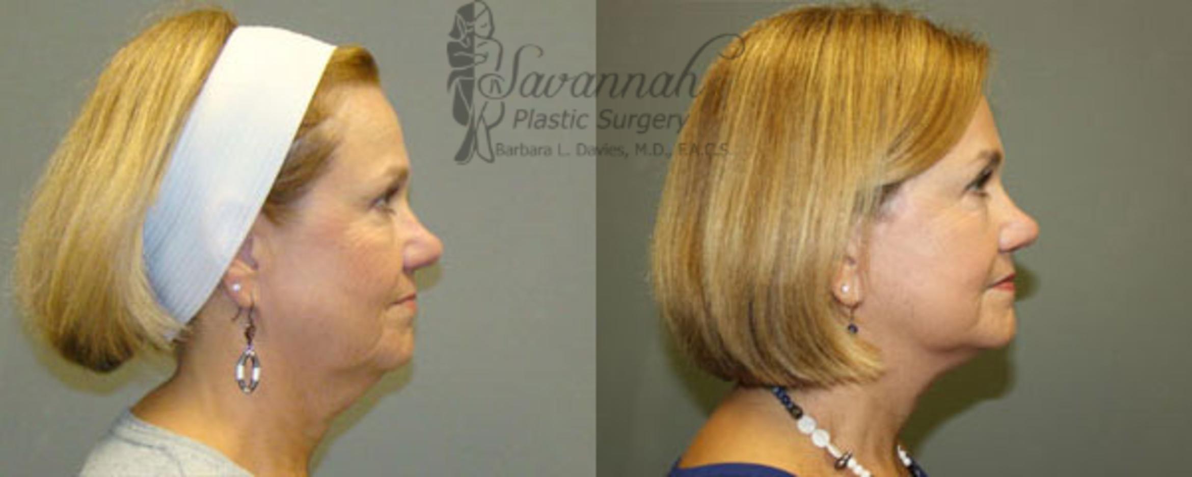 Before & After FreshLook Lift® Case 81 View 2 View in Savannah, Georgia